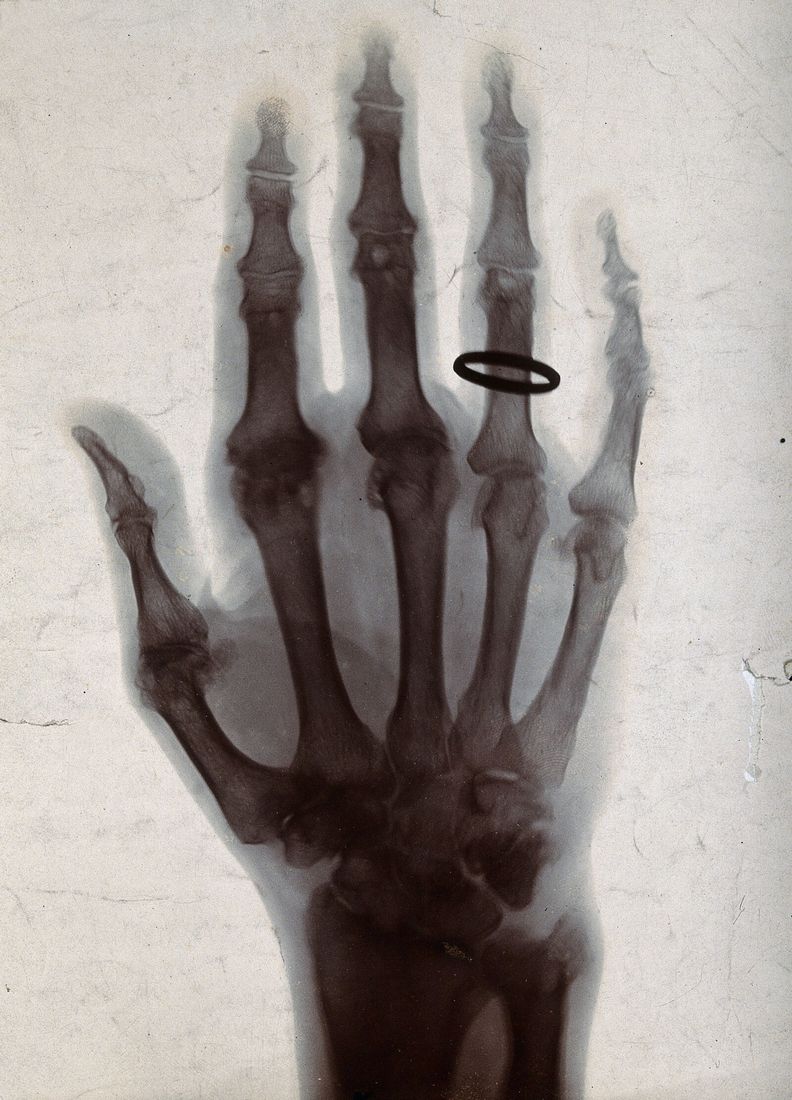 Radiographie ancienne d'une main dont on voit les os des doigts et une bague sombre à l'annulaire